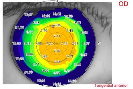 Figur 1-2:Corneal kupighet för den främre ytan av cornea på ett friskt öga. Orange färg visar kupigt område.