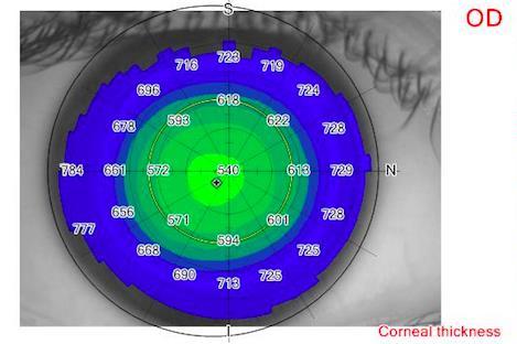 Bilden visar corneal topografi för en av deltagarna i studien. Figur 1-3: Corneala tjockleken för ett normalt öga.