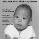 Fosterskador Embryonalperioden känsligast FAS 0,42 %, FASD 4,8 % (USA) Ökad frekvens obesitas, hjärt- kärlsjukdom, njurskador