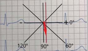 Figur 9. Bilden ovan visar koordinatsystemet med grader utplacerat (utifrån Einthovens triangel).