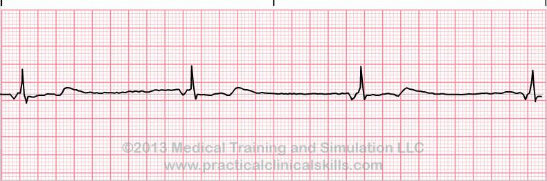 Isoprenalin och eller pacemaker Om