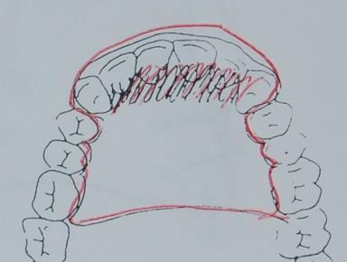 Indikationer: postnormalt djupbett (pat får inte vara basalt öppen, d.v.s. stor vinkel mellan maxillan och mandibeln).