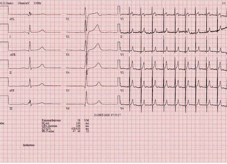 Del 2 EKG tas.