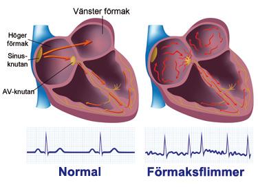 Förmaksflimmer Vad är