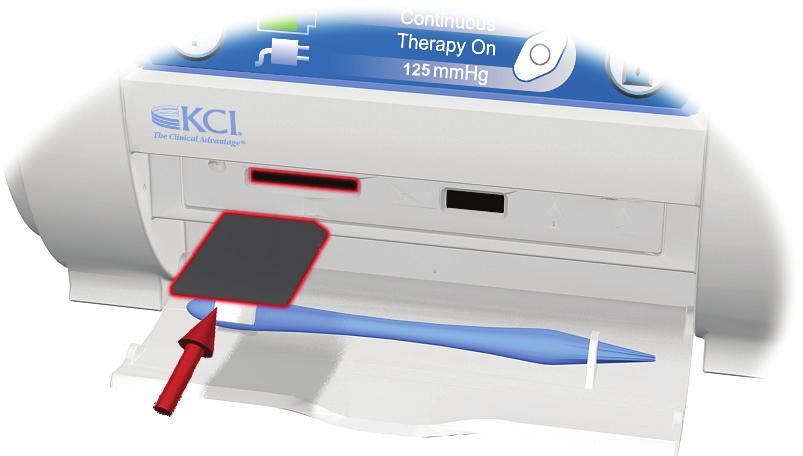 Skärmen Överför minneskort Minneskortplatsen får endast användas av auktoriserad läkare. 1. Sätt i minneskortet i minneskortplatsen på INFOV.A.C. Therapy-enheten.