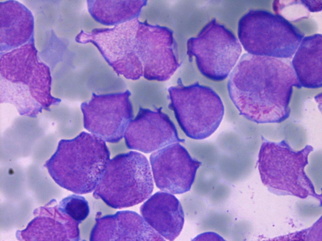 Akut promyelocytleukemi AML med PML-RARA t(15;17) (q22;q12) Specifik