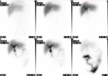 Cholescintigrafi Preparat: 99m Tc-Mebrofenin: nästan 100% utsöndras via