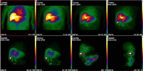Scintigrafi av transplanterad