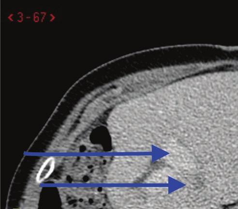levermetastaser Metastas (nedre pilen) invid en gren från vena porta (övre pilen) hos en patient med kolorektal cancer med levermetastas som tidigare