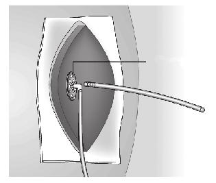 Placera biten med V.A.C. WhiteFoam-förband direkt över det icke vidhäftande materialet på fistelöppningen. Svampen ska vara 1 2 cm större än fistelöppningen. 7. Klipp och placera ett V.A.C. GranuFoam -förband försiktigt i det resterande såret.