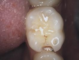 Om ett utbytbart Proxihuvud används kan en lesion upptäckas mesialt på tand 36 (bild 2).