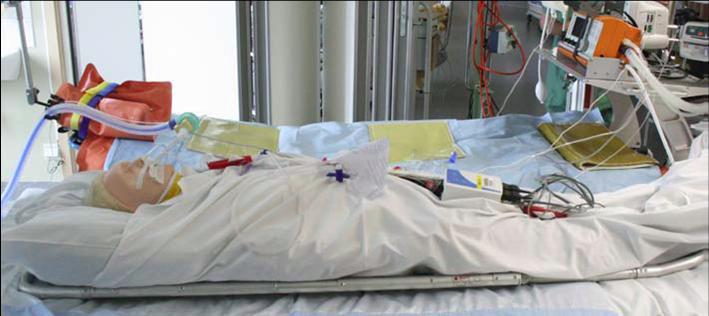 När Ortivus övervakning används kommer eventuell koppling till artärtrycket att vara den enda kabel som är utanför patienten.
