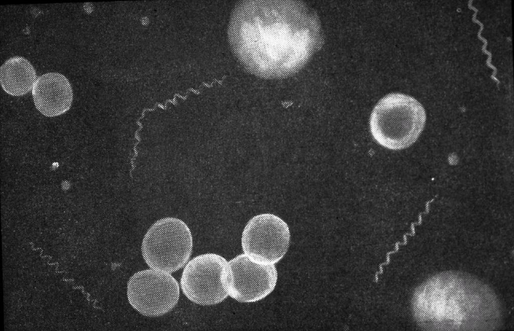 Syfilis Treponema pallidum (gramnega4v spirochet) WHO 6 miljoner nya fall / år (WHO sept 2017) Ökar i Sverige, 2017: 389