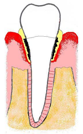 Parodontit Kronisk inflammation Omfattar