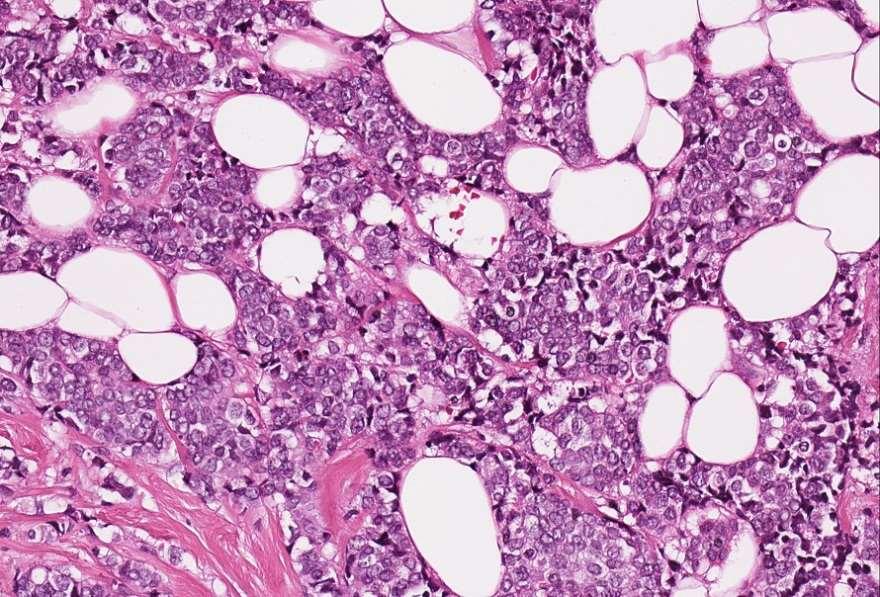 Figur 2: Hematoxylin-eosin-färgning av ett preparat från bröstcancer. Bestämning av antal mitoser görs på preparat färgade med denna färgning (400x förstoring).