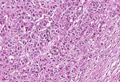 1.5 Behandling Vanligen behandlas bröstcancer med kirurgiskt ingrepp (3). Innan operation utförs rutinundersökningar som EKG och ibland även hjärt- och lungröntgen (10).