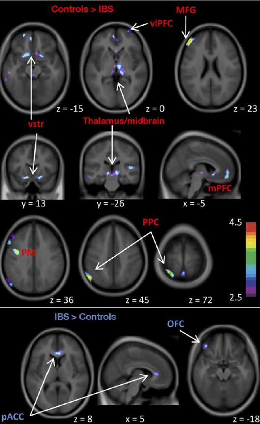 Morphometric differences in parts of the brain may be