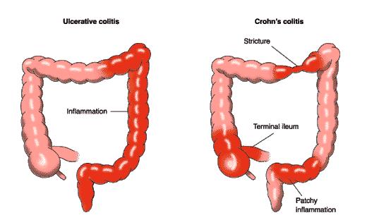 Crohns
