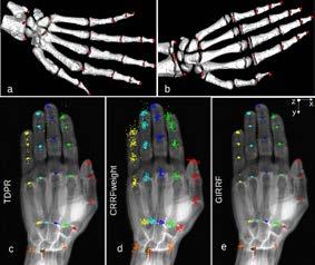 Samstämmigheten mellan två bedömare är 85%. Andra studier har visat en möjlighet att bedöma övre delen av skenbenet (proximala tibia) hos både pojkar och flickor [6, 17].