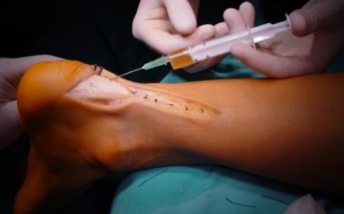 Platelet-rich plasma- PRP PRP har använts oerhört mycket Evidens- baserad?