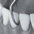 SICKLAR För att avlägsna supragingival tandsten. Instrumentens användning: Lägg en tredjedel av sickelns skärande egg mot tanden vid borttagning av tandsten.