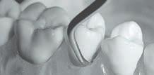 UNIVERSALKYRETTER Utformade för att avlägsna måttlig till kraftig tandsten från alla supra- och subgingivala tandytor.