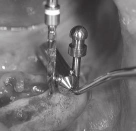 hjälper till att placera den första spiralborren på korrekt avstånd från implantat eller naturlig tand intill implantatet med hänsyn till benstrukturen.