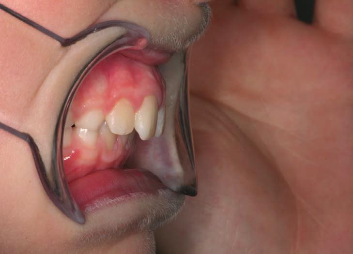 ORTODONTI Silikonaktivator och inpassare för växelbett: Styr tänder Aktiverar