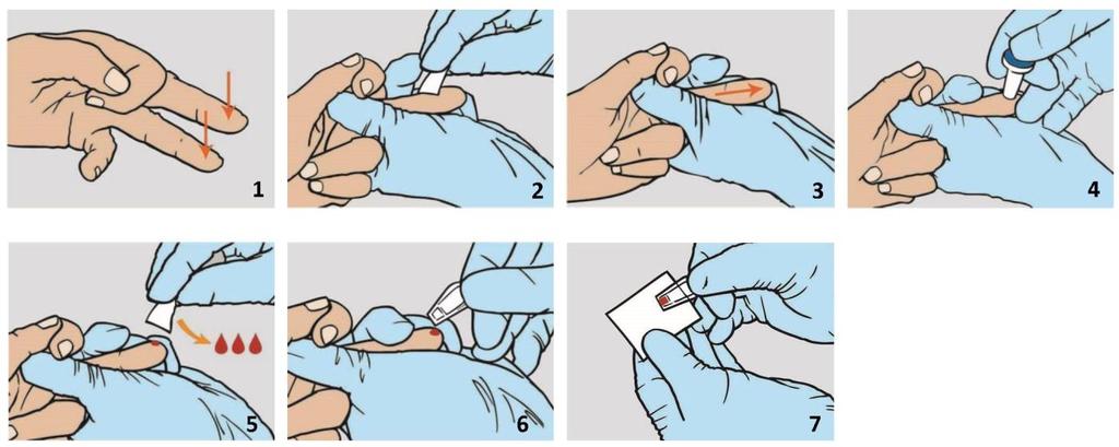 6. Provtagning och förberedelse för mätning Kapillärt, venöst eller arteriellt (antikoagulerat med EDTA eller heparin) blod kan