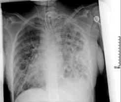 Pneumoni Pneumoni (lunginflammation) definieras som en infektionsutlöst inflammation i