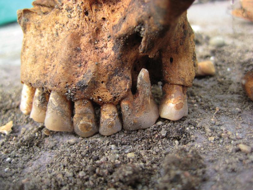 Hos skelett A hade ledändarna (epifyserna) på rörbenen inte vuxit samman med själva benkroppen (diafyserna) vilket visar att individen var yngre än 16 20 år.