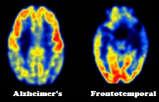 Procedurminne: Dyspraxi Priming Budson & Price, Practical Neurology 2007;7:42-47 FRONTOTEMPORAL DEMENS, FTD