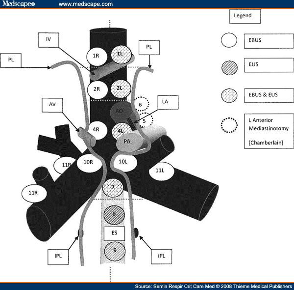 Figur 9.2 Mediastinal staging hos patienter med NSCLC inför kurativt syftande behandling. Algoritm modifierad från ESMO-guidelines.