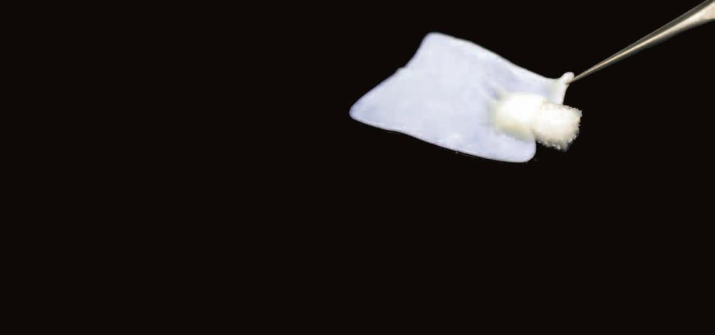 > > kan kombineras med många olika benersättningsmaterial ingen bestämd orientering - båda sidor användbara FINNS DET NÅGON RISK ATT MEMBRANSIDOR- NA KAN FÖRVÄXLAS OCH HAMNA FEL UNDER APPLICERINGEN?