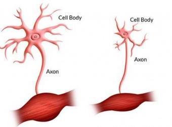 ALS- amytrofisk lateralscleros ICD 10 G12.2 Motorneuronsjukdom.