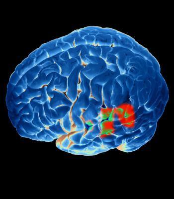 Dopamin, avgörande signalsubstans för hjärnans förmåga att styra kroppsrörelserna Nedbrytning av dopaminhaltiga nervceller i hjärnan Lewykroppar (α-synukleinaggregat) # 20/8-2018 FORSKNING &