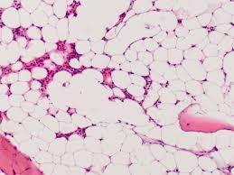 hypocellulär Cytogenetik: 6p, 7 och/eller 13.