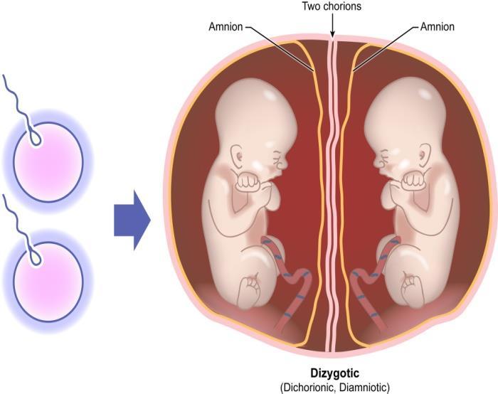 Tvillingtyper Tvåäggs (dizygota), 2 ägg + 2 spermier.