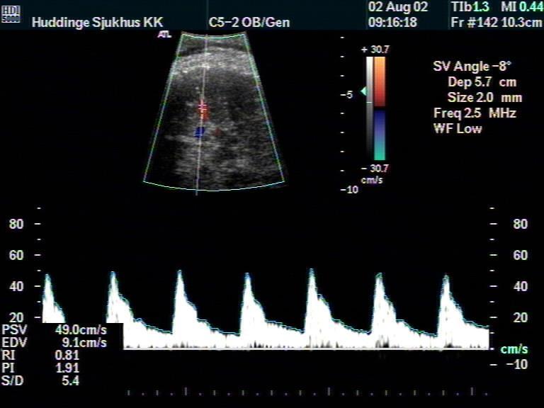 Fetal anemi (Vmax MCA