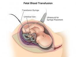 Blodtransfusion