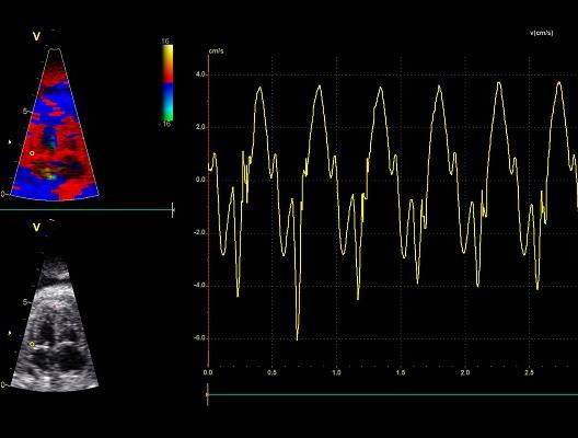 Tissue Doppler Imaging (TDI) Cine-loops av 4-kammarbild med TDI mode.