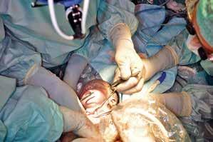 Figur 3. EXIT-operation och förlossning vid larynxatresi med påbörjande av trakeotomi och samtidig intraoperativ ekokardiografi. FAKTA 1.