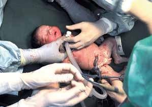 Reversering av iatrogen trakealocklusion efter fosterkirurgi för diafragmabråck EXIT-till-ECMO Massiva lungtumörer CPAM (congenital pulmonary airway malformation; kongenital missbildning av