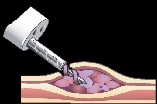 Om BiBBInstruments BiBBInstruments har utvecklat teknologin EndoDrill, vilken möjliggör vävnadsprover (biopsier) av hög kvalitet.