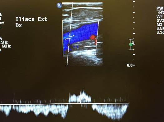 femoris så långt det går och v femoralis med färgdoppler ned till knät. - Tydligt svar på distal kompression (med hand/manschett) Figur 2- "Mickey mouse view" en lätt identifierbar nivå i ljumsken.