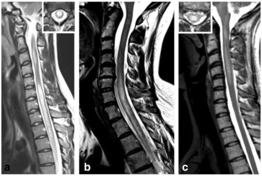 MRI Ryggmärgslesioner Jarius