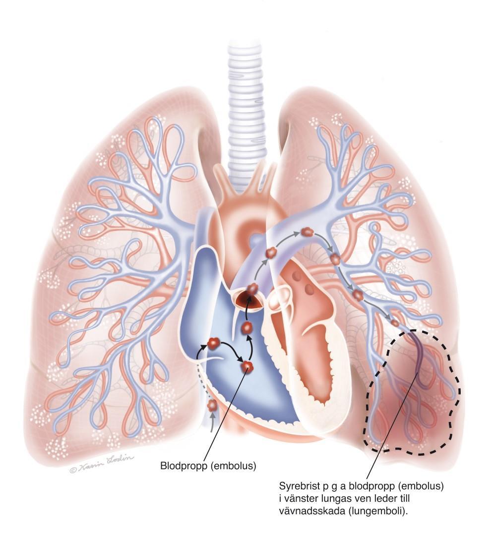 Lungemboli Ventilations- perfusionsmismatch Hemodynamisk