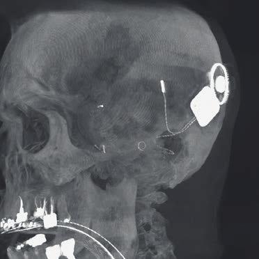 387 mm) I fallet med denna 71 år gamla patient vid Universitetssjukhuset i Essen i Tyskland visas de fina elektroderna, som bara är 0,3 mm breda, tydligt tack vare systemets goda bildupplösning.