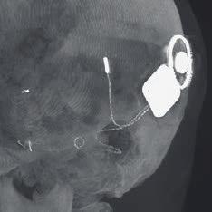 Korrekt placering av elektroden, intraoperativt verifierad med Vision RFD 3D CMOSline, ger ett optimalt hörselresultat för patienten. mindre dos jämfört med detektorer tillverkade av amorft kisel.