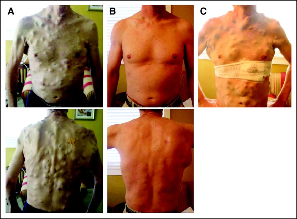 A 38-year-old man with BRAF-mutant melanoma and miliary, subcutaneous